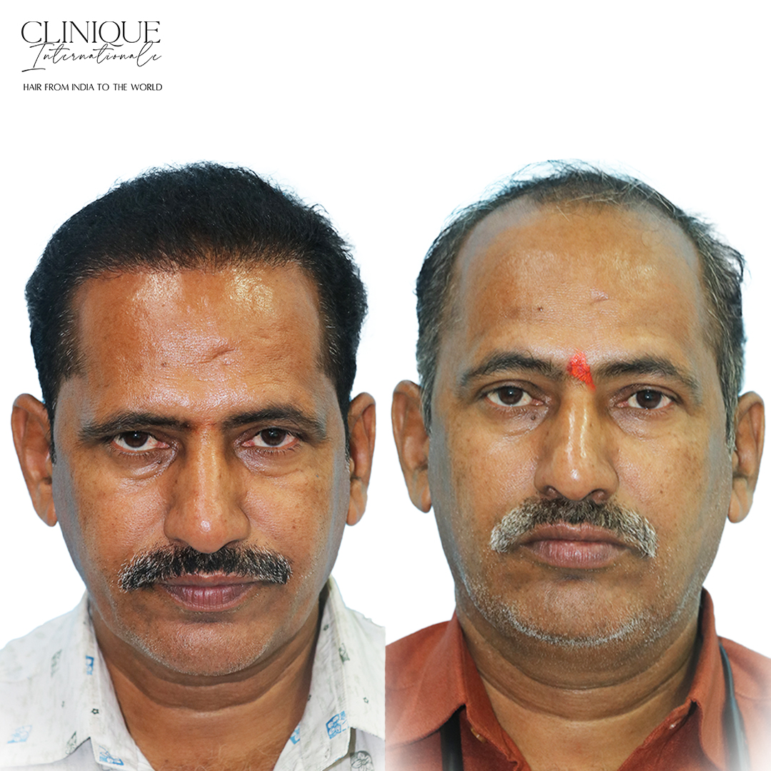 Hair Transplant Before After – Abhay Patil, Mumbai