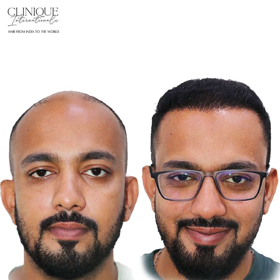 Hair Transplant Before After – Akhil Mahajan, Mumbai