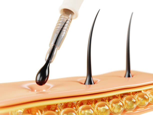 FUE follicle extraction and implantation