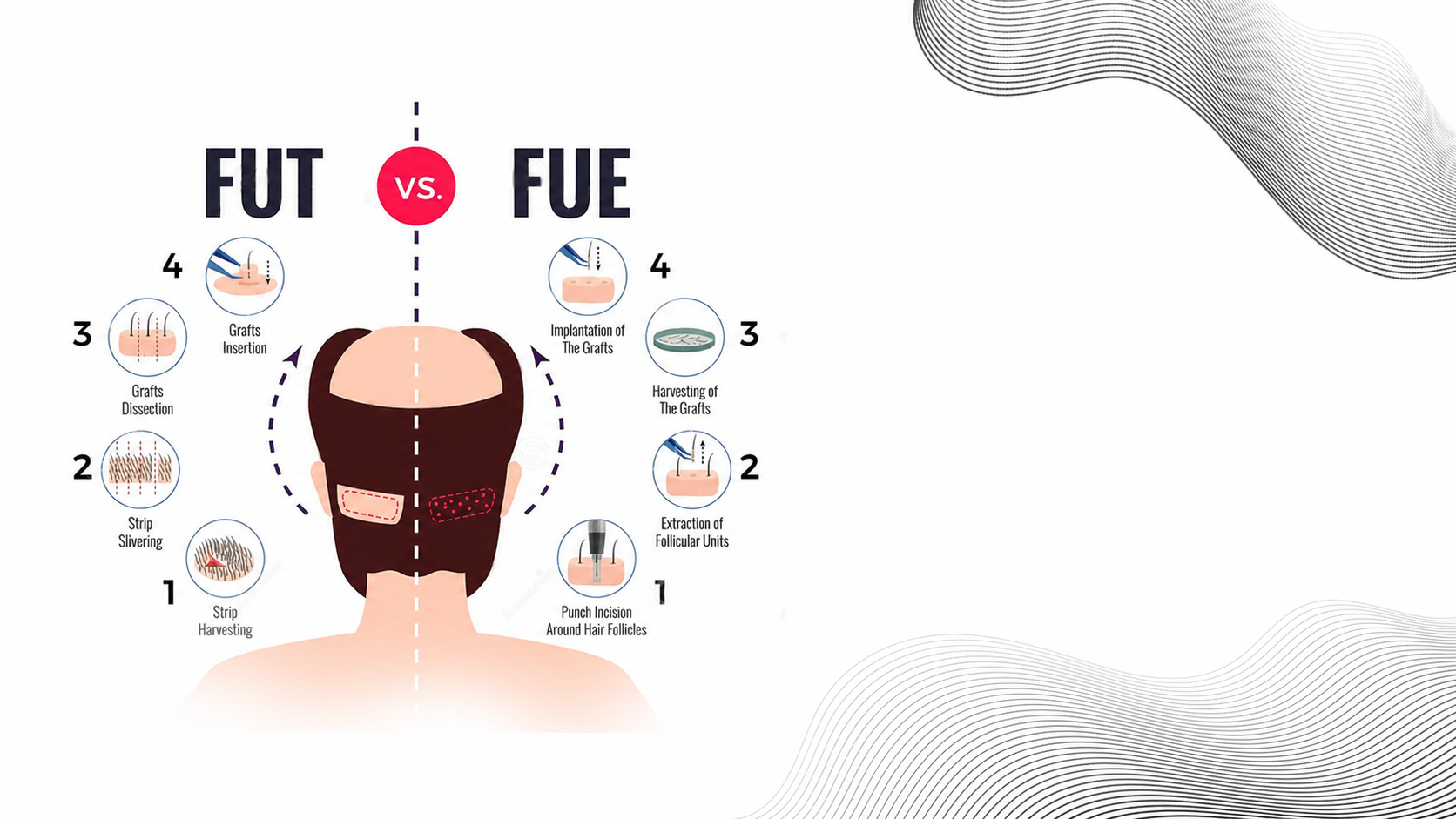 FUT Hair Transplant
