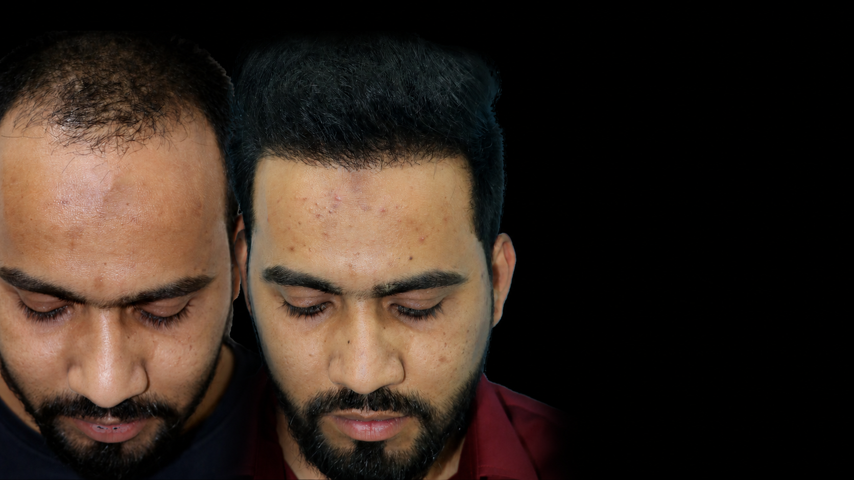 Hair Transplant Surgery in Navi Mumbai